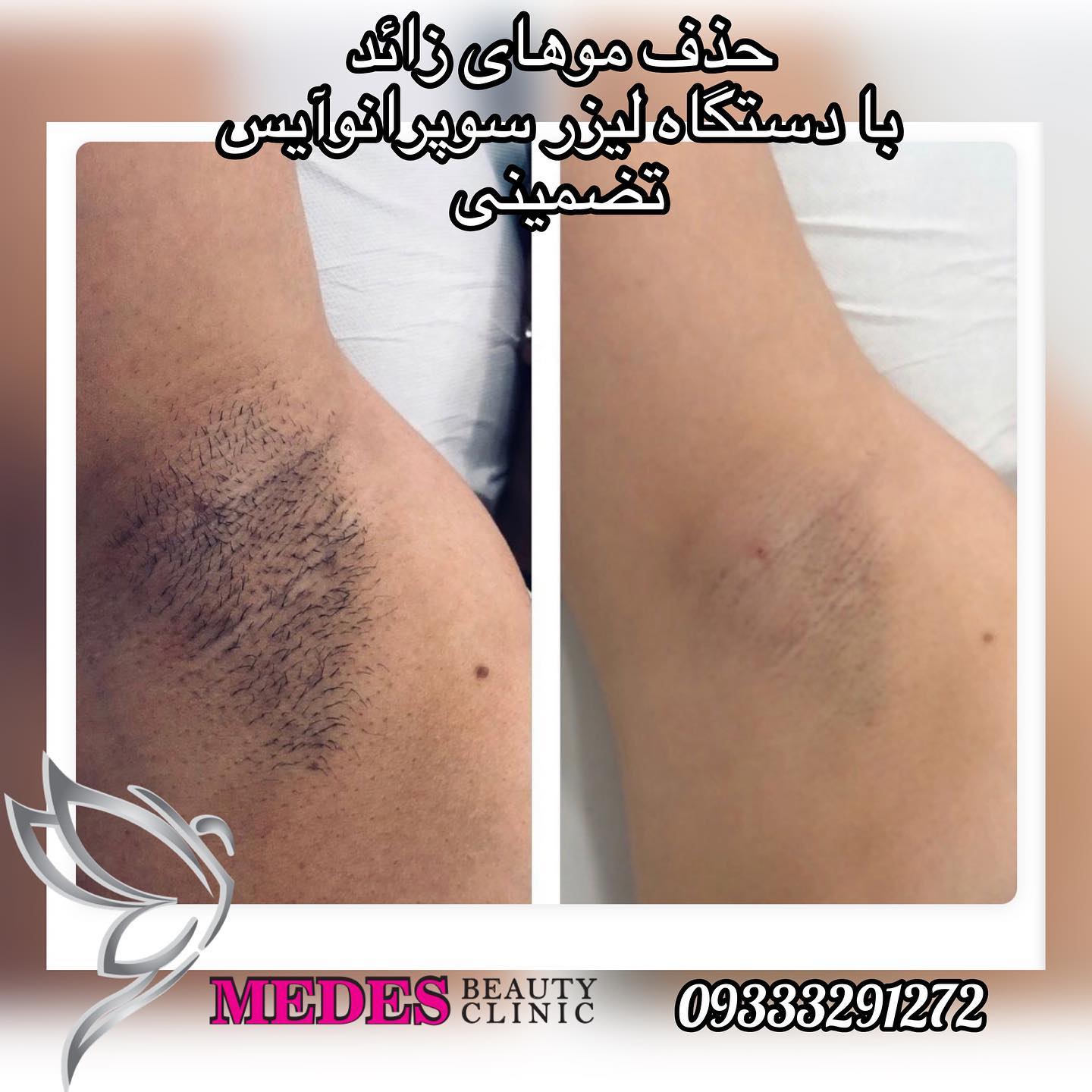 گالری لیزر مو زائد